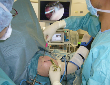 関節鏡手術とは | 肩関節鏡手術の職人 鈴木隆