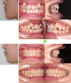 3.外科矯正～顎口腔機能診断指定医療機関としての保険適用治療