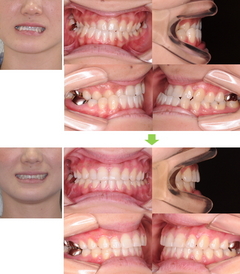 3.外科矯正～顎口腔機能診断指定医療機関としての保険適用治療