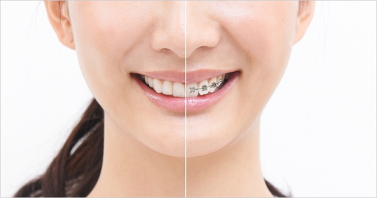 矯正装置の比較 - 豊中市岡町で歯列矯正治療なら、まつもと歯科