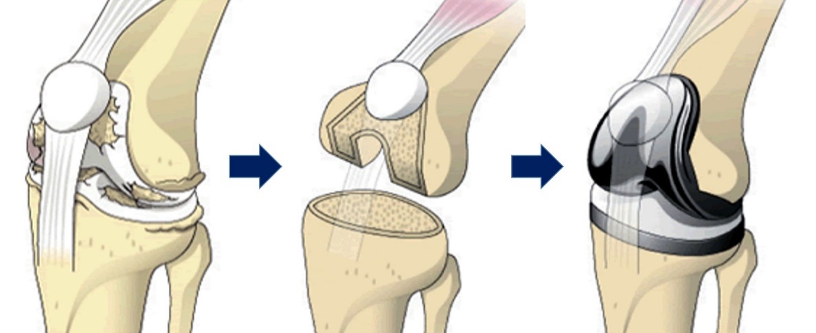 人工膝関節について | 診療科・部門 | 済生会横浜市南部病院