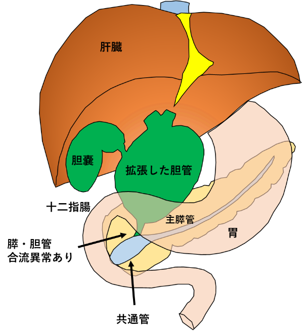 肝胆膵 – 腹腔鏡・ロボット支援総胆管拡張症手術 | 消化器外科 | 医療