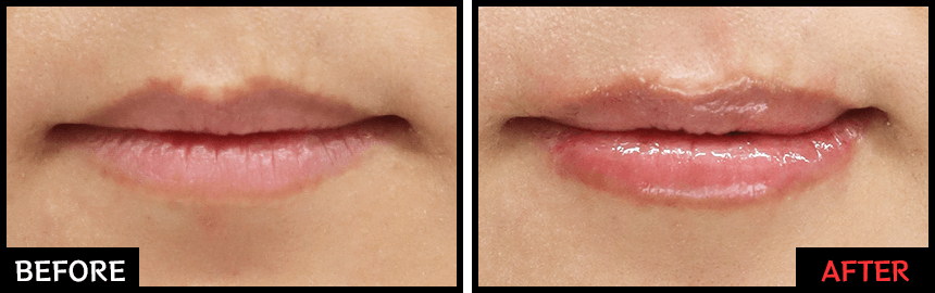 唇のヒアルロン酸注射「レッド・グロス注射」 | 品川美容外科【公式】