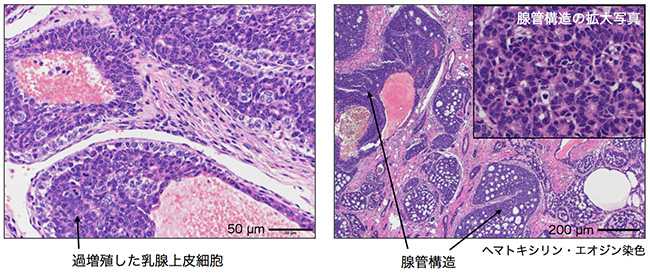 乳がんを抑制する新たな遺伝子を発見―ヒト乳がんの診断・治療への応用