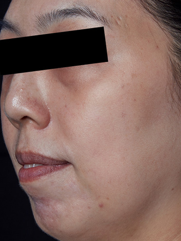 ピコウェイによるシミ取りの症例 | ZX-CLINIC【公式】｜大阪梅田・北