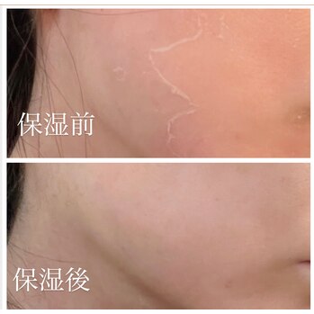 剥離あり」ハーブピーリング 3回目 3日目 | Genie（ジーニー）