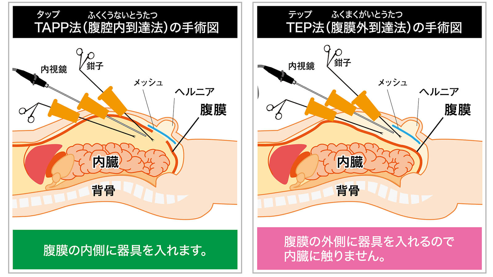 鼠径ヘルニア（脱腸）の手術｜お腹に入らない手術（SILS-TEP法）って