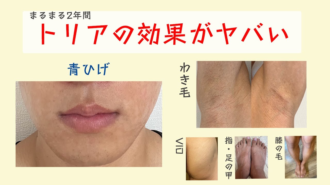 3年目】トリアの脱毛効果がマジでヤバすぎた。ヒゲ・脇毛・VIO 完全