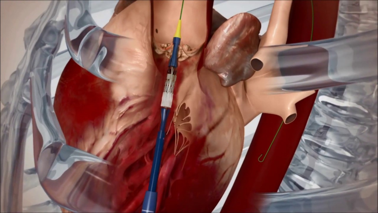 心臓弁膜症の外科的治療 | 外科系 | 一宮西病院 | 社会医療法人 杏嶺会