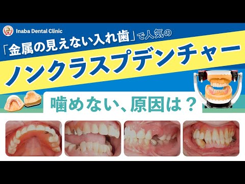 Non-clasp dentures - What's the reason for not being able to chew