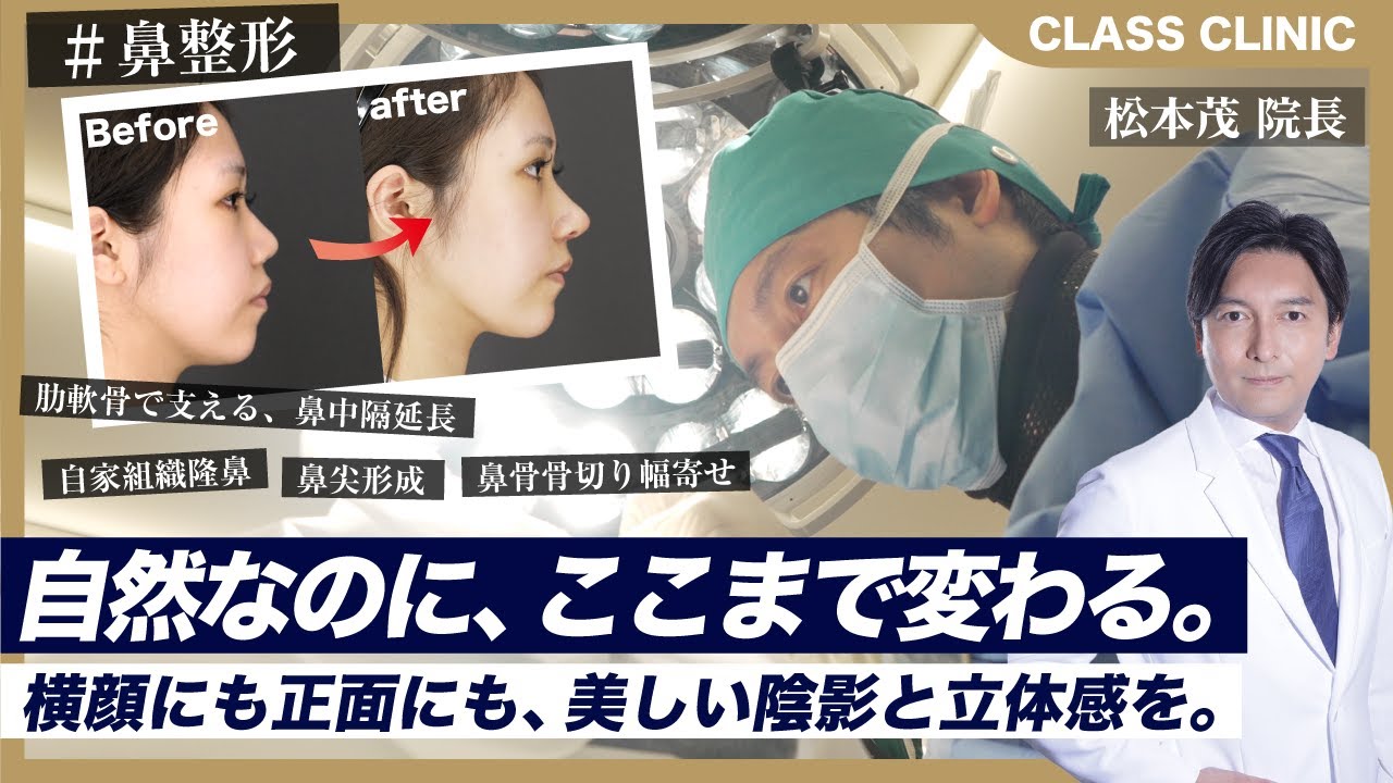 Before → After Video Released] Nose Surgery that Changes the