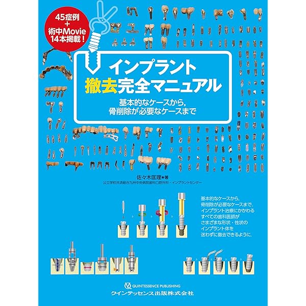 インプラント補綴マニュアル: パーツで困ったときの取扱説明書 | Todd
