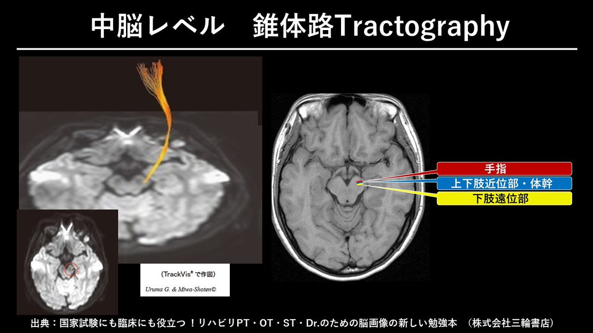 臨床に使える脳画像🌈 おはようございます。 ～拡散テンソル画像 錘体