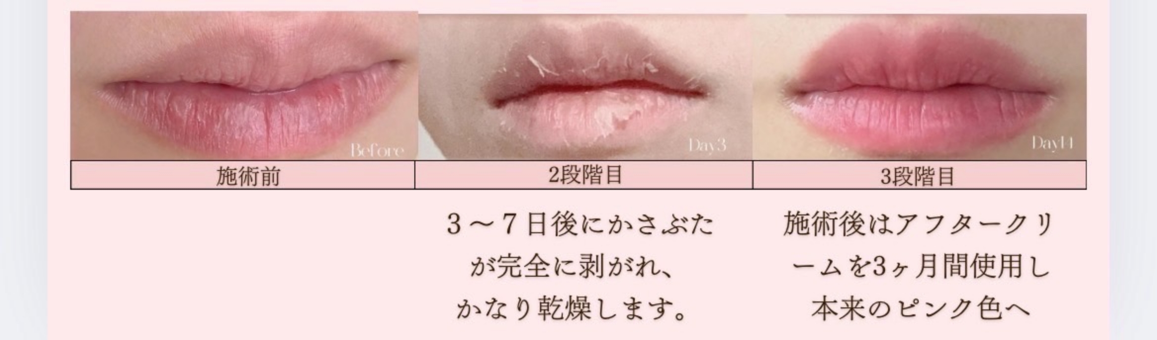 ローマピンク| 美容外科SOL CLINIC