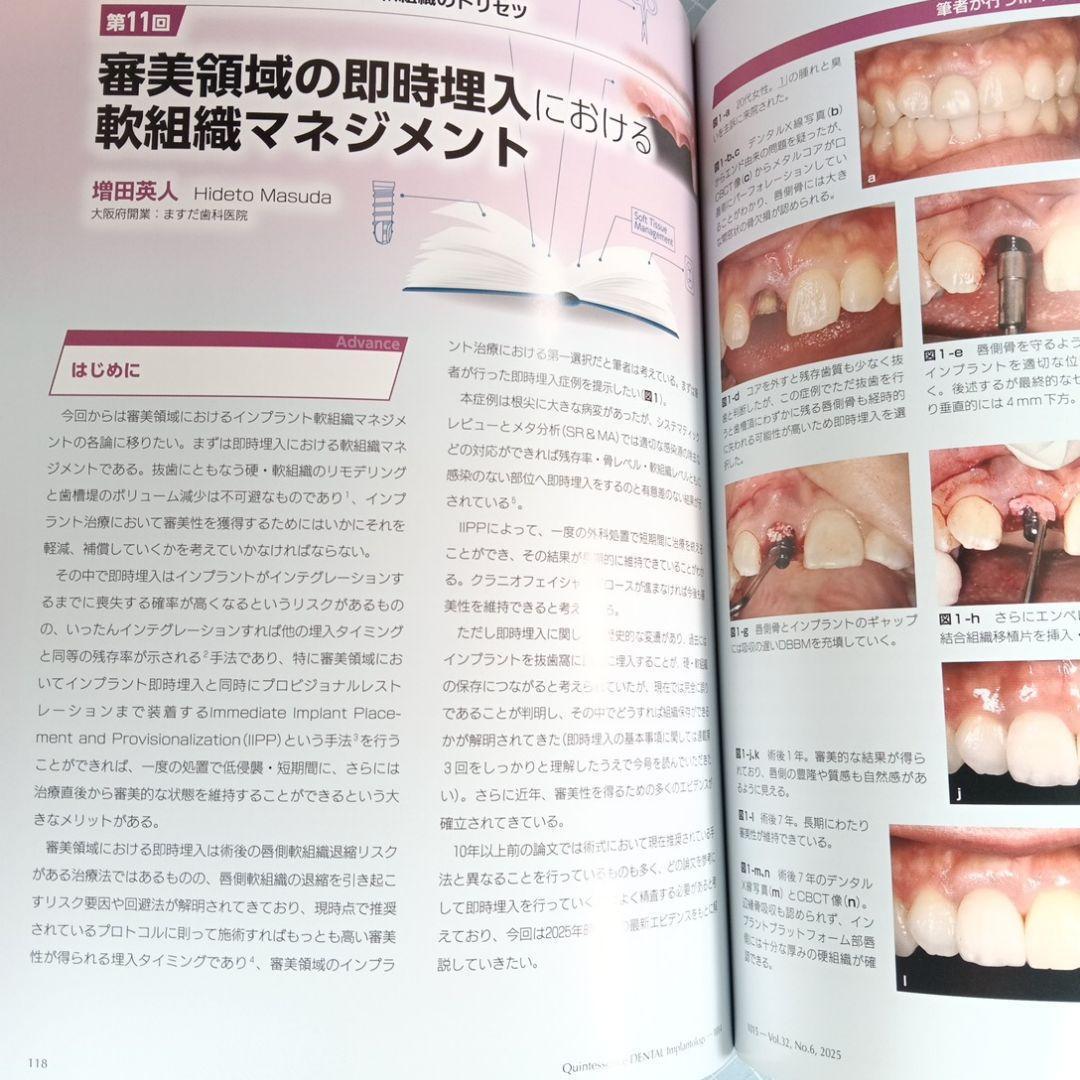 クインテッセンス・デンタル・インプラントロジー 2025-6 永久歯の先天