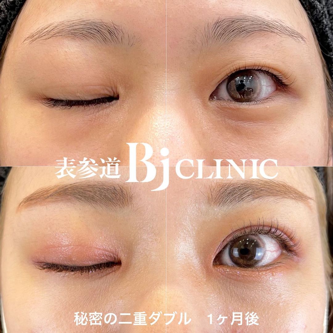症例写真 | 表参道Bjクリニック美容外科・美容皮膚科｜ヒアルロン酸